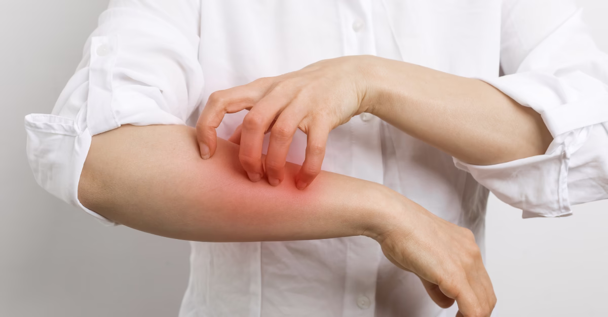 Image of person scratching arms as though having a histamine intolerance reaction
